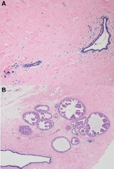 Figure showing histology changes in mastectomy specimens from transgender women on long-term androgen (testosterone) therapy. Key histology features include lobular atrophy with atrophic ductal epithelium and stromal hyalinization/fibrosis (panel A) and fibrocystic changes with apocrine metaplasia and calcification (panel B).