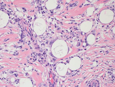 Figure showing an example of histologic changes resulting from a gender-affirming surgery but unrelated to gender-affirming hormone therapy. The image shows histology from a surgical pathology specimen from tissue involved in an augmentation procedure that results in foreign body-type reaction with exogenous foreign material consistent with silicone implant particles associated with multinucleated giant cell reaction, fat necrosis, and stromal fibrosis.