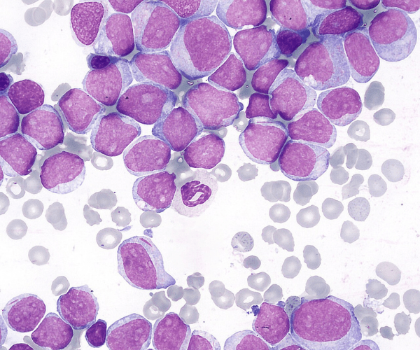 illustration of acute myeloid leukemia cells