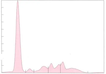 Is There an M-spike in the Globulin Fraction of This Sample?-3