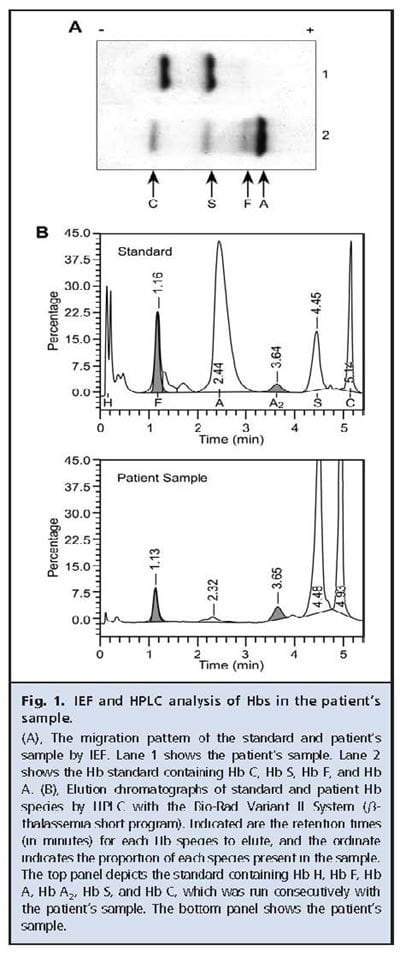 Fig 1 IEF and HPLC analysis of Hbs in the patient's sample