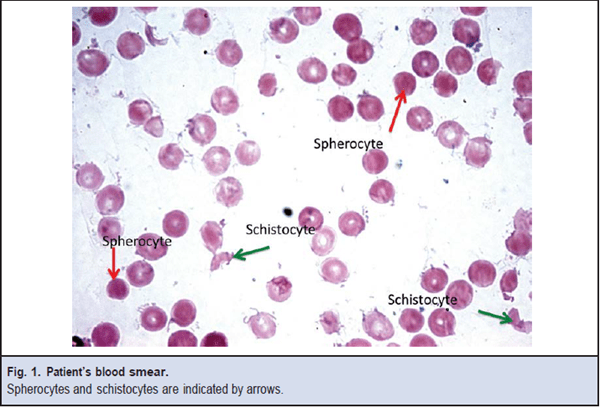 Figure 1. Patient's blood smear