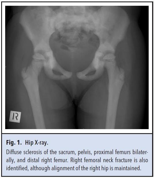 Fig 1. Hip x-ray