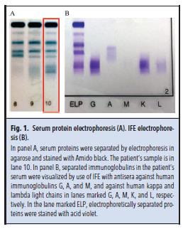 Fig 1. Serum protein electrophoresis (A). IFE electrophoresis (B)