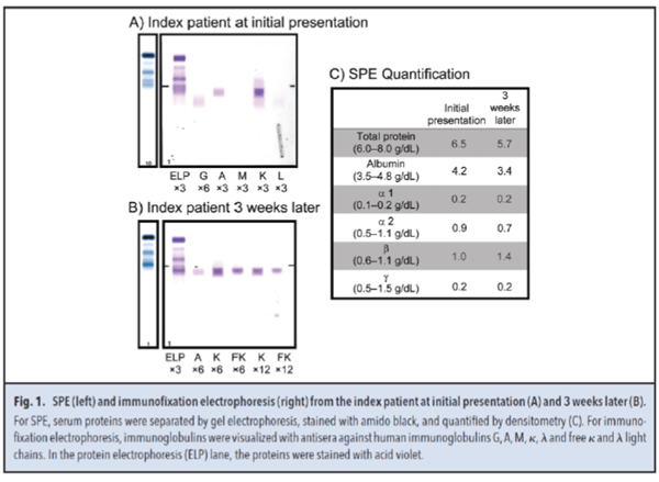 Figure 1. SPE (left) and immunofixation electrophoresis (right) from the index patient at initial presentation (A) and 3 weeks later (B)