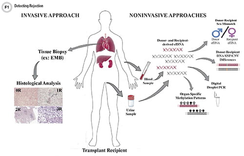 Detecting rejection in transplants