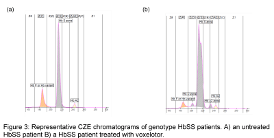 Sickle cell chromatogram