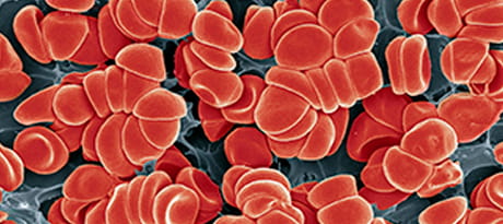A representation of many red blood cells clumping together to illustrate blood clotting