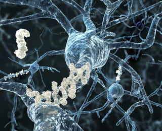 Alzheimer’s graphic